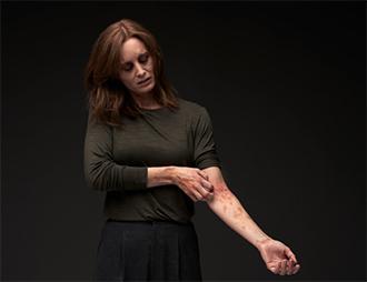 Una donna con dermatite atopica non reale guarda verso il basso e si gratta una lesione diffusa sul braccio sinistro a causa del forte prurito di cui soffre.