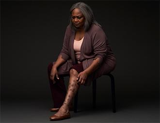 Una donna con prurigo nodularis non reale si china per grattarsi dei noduli duri e in rilievo sulla parte inferiore della gamba a causa del forte prurito di cui soffre