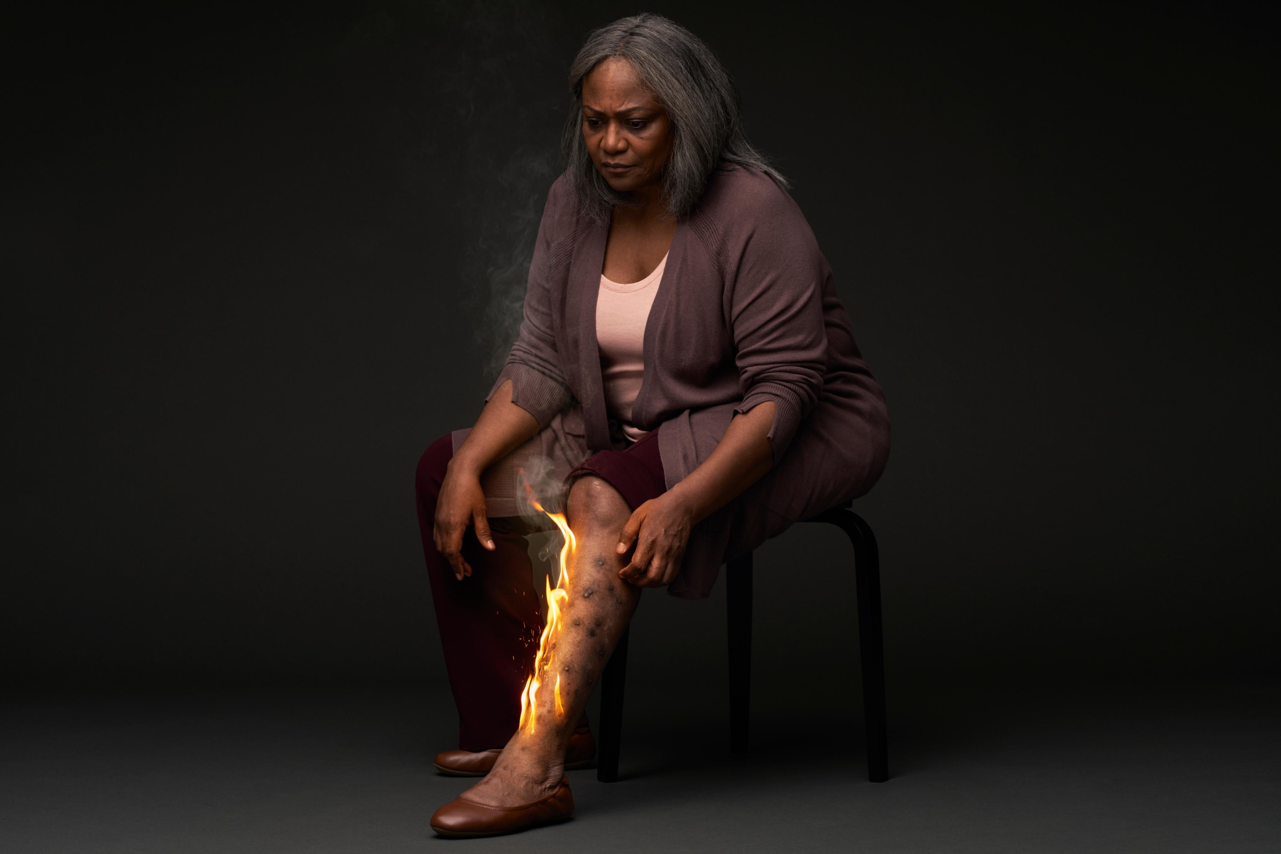 Una donna con prurigo nodularis non reale si china  per grattarsi dei noduli duri sulla parte inferiore della  gamba a causa del forte prurito di cui soffre.