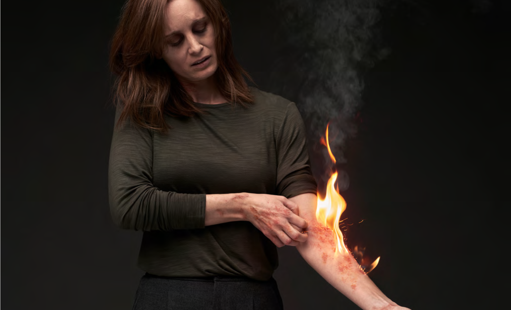 Una donna con dermatite atopica non reale guarda  verso il basso e si gratta una lesione diffusa sul  braccio a causa del forte prurito di cui soffre