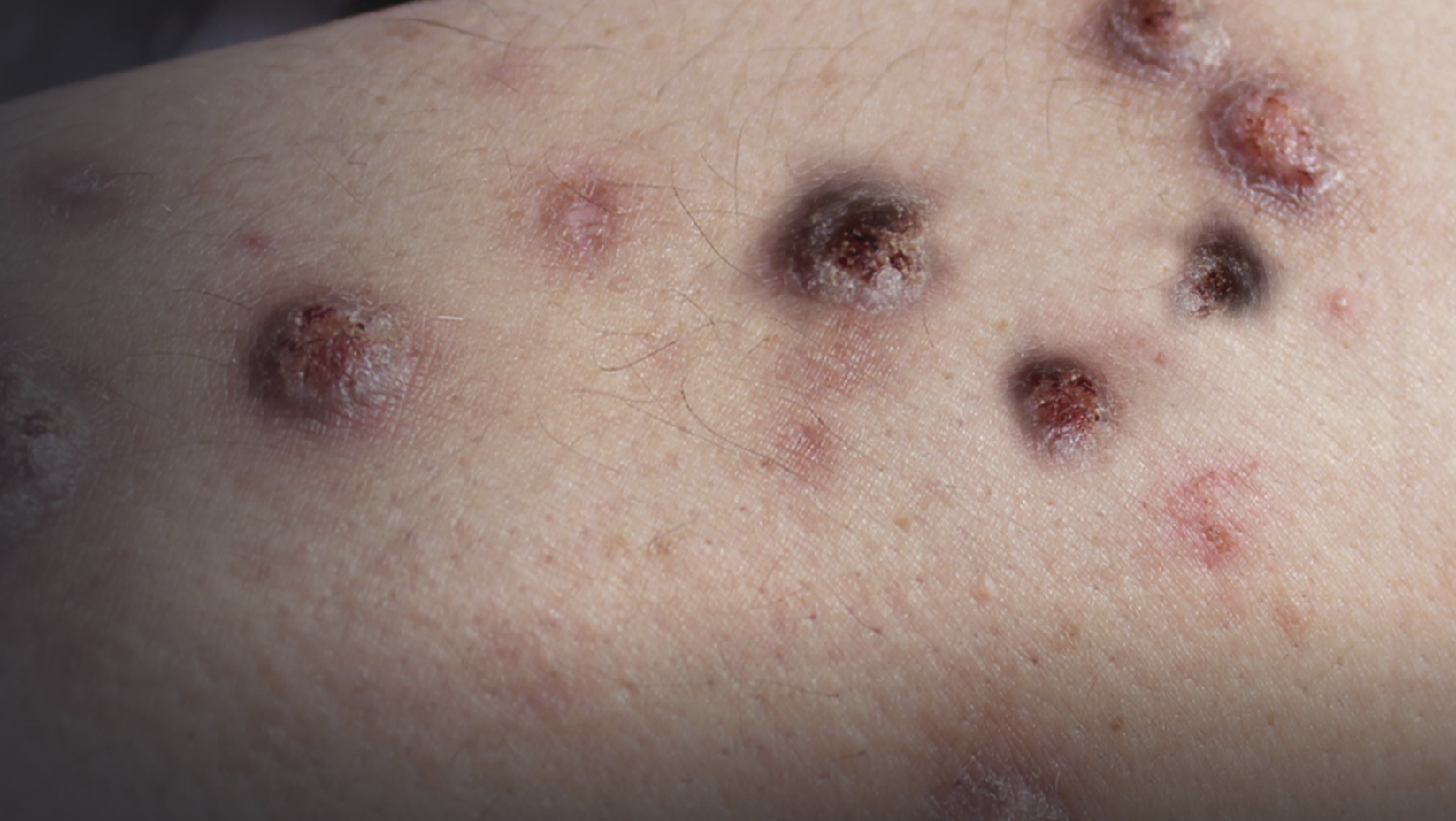 Raffigurazione delle lesioni/noduli della prurigo  nodularis