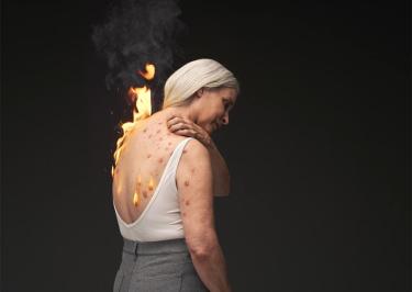 Una donna affetta da prurigo nodularis non reale si porta la mano dietro la schiena per grattarsi i  noduli solidi e sporgenti causati dal forte prurito  di cui soffre.