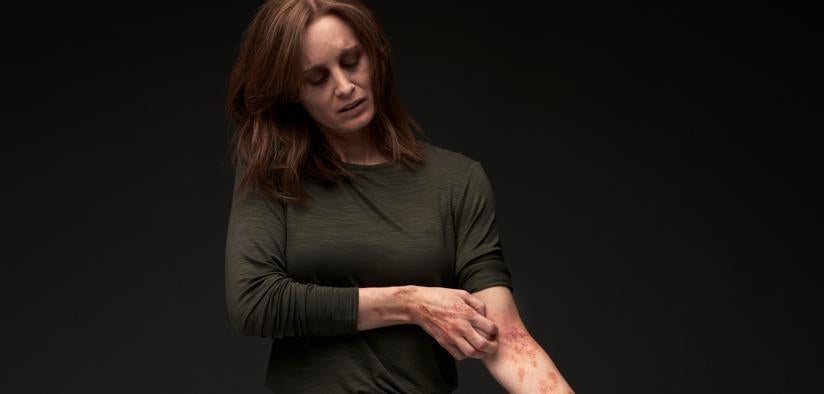 A woman with simulated atopic dermatitis gazes downward and scratches a diffuse lesion on her left arm due to severe itch she suffers